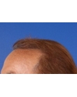 After Hair Transplant&nbsp;2 Sessions (Areas)
